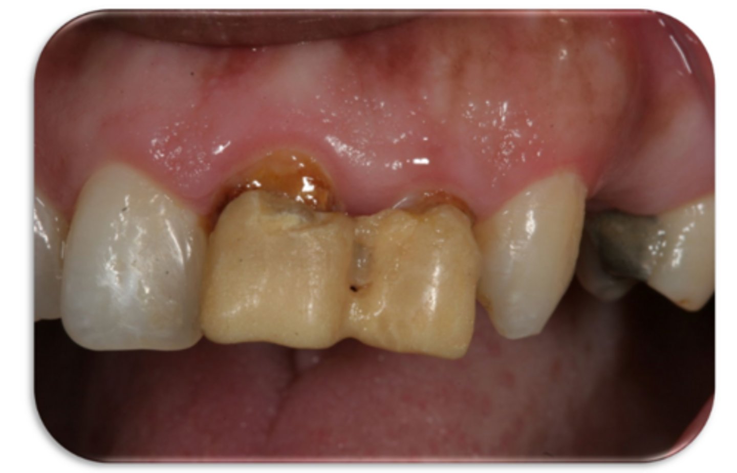 <p>What are the problems associated with these provisional restorations?</p><p>A. There is not enough space for materials so the temporary restorations are overcontoured</p><p>B. The shade does not match the adjacent teeth</p><p>C. The anatomical form does not follow the anatomical form of the adjacent teeth</p><p>D. All of the above</p>