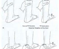 positive result is first ray rises with tib fib external rotation