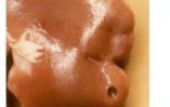 <p>margin of the lesion</p>
