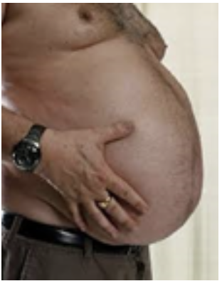 <p><span>How would you document the shape of this abdomen?</span></p><p></p>