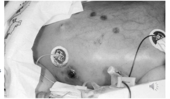 <ul><li><p><strong>Cutaneous aspergillosis </strong>– primary infection due to<strong> skin damage (h</strong>ealthy or immune compromised). - s<strong>econdary manifestation due to disseminated disease.</strong></p></li><li><p><strong>Risk factors</strong> – trauma, neonate, immune compromised host. A. fumigatus, A flavus commonest</p></li><li><p>A. flavus causes <strong><mark data-color="#c5ffc5" style="background-color: rgb(197, 255, 197); color: inherit;">aflatoxicosis </mark></strong>due to ingestion of toxin produced in contaminated foods (peanuts), healthy host</p></li></ul><p></p>