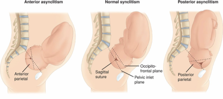 <ul><li><p>Fetal head is tipped towards one shoulder laterally, causing it to engage with the pelvis in an uneven, lateral, or oblique angle </p></li><li><p>Anterior: anterior parietal bone is closer to pelvis, making the sagittal suture closer to the sacrum </p></li><li><p>Posterior: posterior parietal bone is deeper in the pelvis, making the sagittal suture closer to the pubic symphysis </p></li><li><p>Severe cases can impede fetal descent </p></li></ul><p></p><p></p>