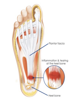 <p>Plantar Fasciitis </p>