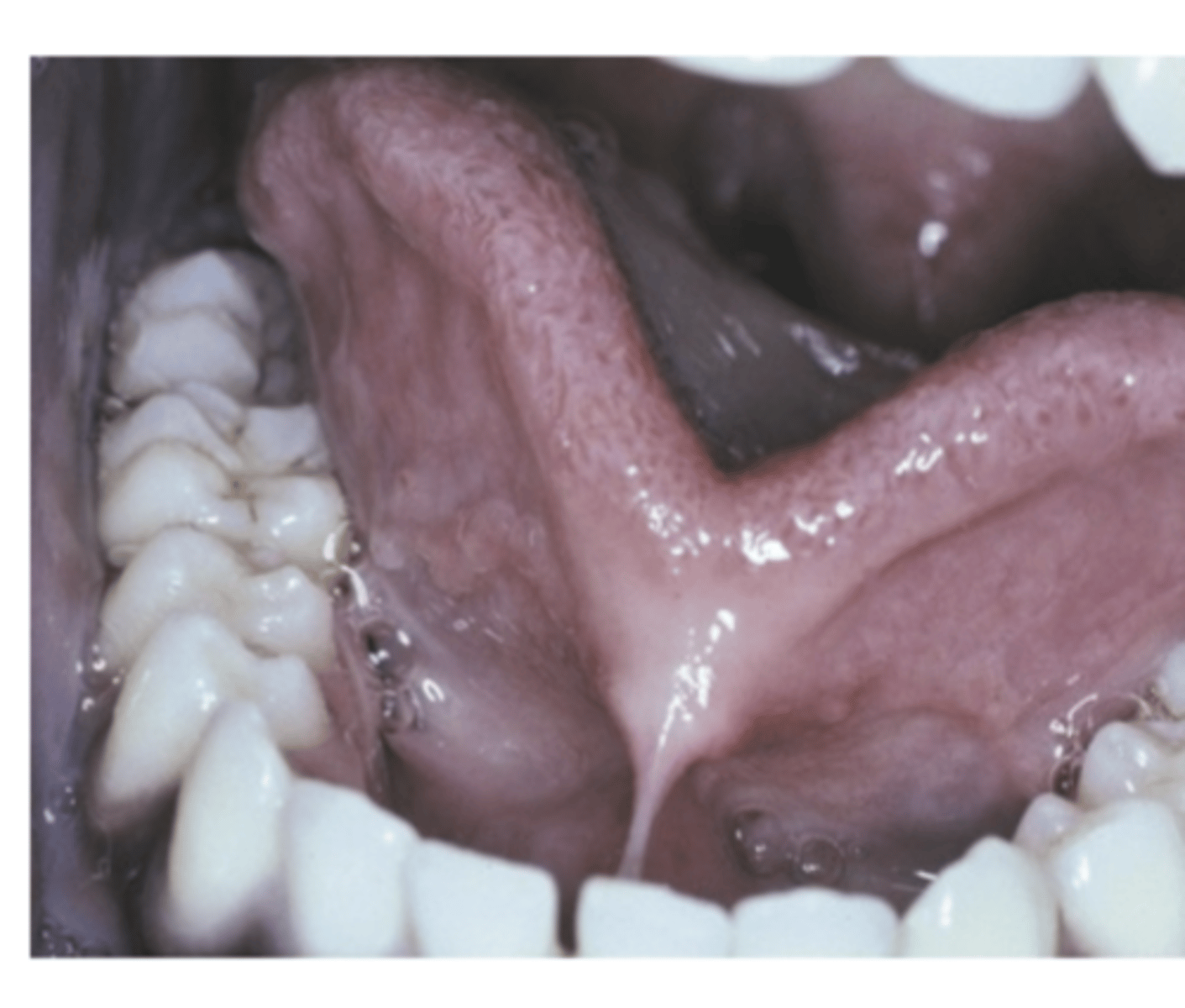 <p>What are the severe cases of Ankyloglossia (3)? </p>