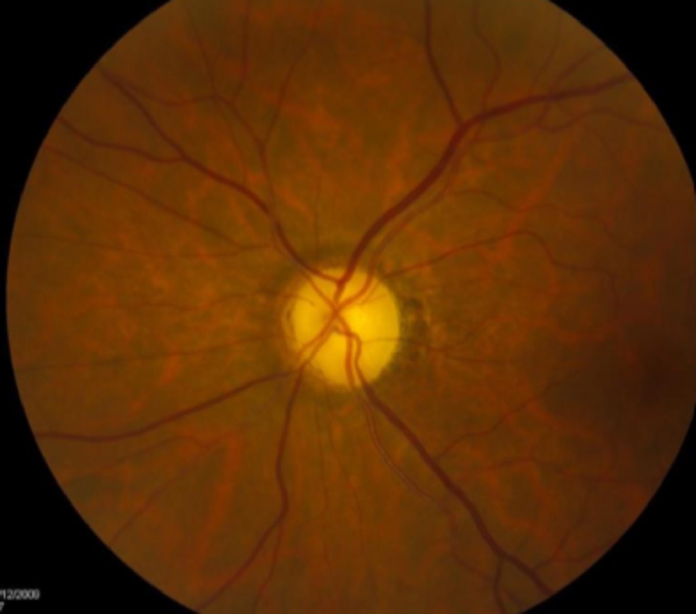<p>optic atrophy</p><p>myopic discs</p><p>neonates discs</p>