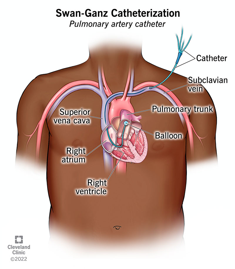 <p>Cardiac output, pulmonary artery pressures, left heart diastolic pressure, and blood oxygenation.</p>