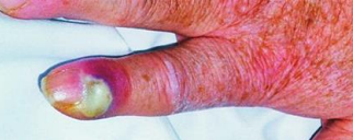 <p><strong>Treatment for Paronychia </strong></p><p>_____ infection without abscess</p><p>-Warm water/antiseptic _____</p><p>-Topical antibiotics: _________, Bacitracin to cover MRSA</p><p>-+/- topical steroid</p><p></p><p>Mild Infection without abscess (not responding to treatment) / _______ infection</p><p>-_________ 500 mg QID</p><p>-Dicloxacillin 250-500 mg QID x 5-7 days </p><p>-Amoxicillin Clavulanate if the patient bites their nails </p><p></p><p>______ Infection</p><p>-Bactrim, Clindamycin, Doxycycline</p><p></p><p>Chronic</p><p>-Topical high potency _______, like betamethasone 0.05%</p>