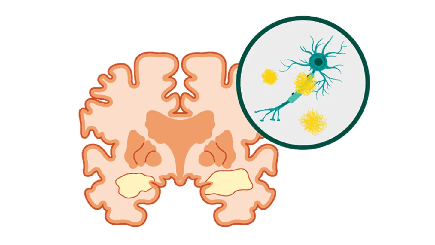 <p>Which protein is associated with widespread brain deterioration in Alzheimer’s?</p>