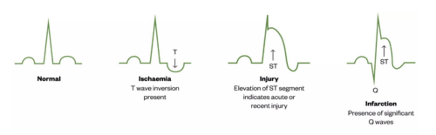 <p>CAD Pathophysiology</p><p>Endothelial injury → LDL oxidation → foam cells → plaque</p><p>Plaque → stenosis → ↓ coronary flow</p><p>Demand > supply → ischaemia → angina</p><p>Plaque rupture → thrombosis → MI</p><p>Angina Features</p><p>Central, crushing pain</p><p>Radiates to arm/jaw</p><p>Exertional ( can measure metres they can walk until)</p><p>Relieved by rest/GTN</p><p>Ischaemia ECG</p><p>ST depression, T inversion ( v2-25) </p><p>MI ECG</p><p>ST elevation, Q waves</p>