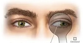 <p><span> an outward drift of the eye.</span></p>
