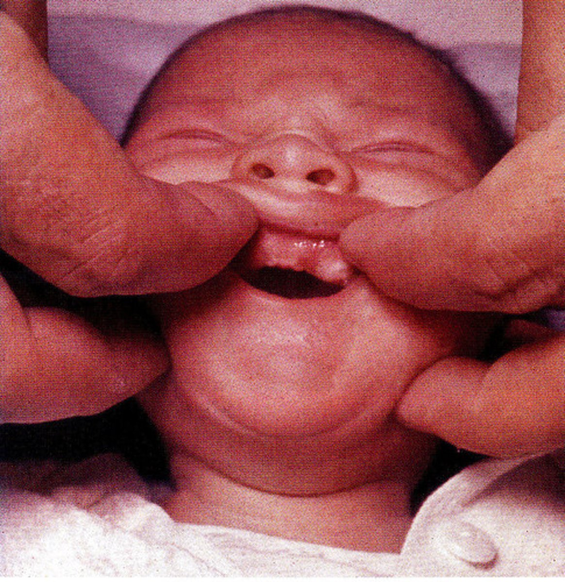 <p>Fusion of the anterior portion of the maxillary gingiva to the lip from canine to canine</p>