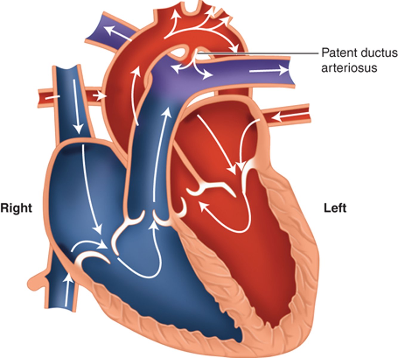 <p>- Patent ductus arteriosus (PDA)</p><p>- Atrial Septal Defect (ASD)</p><p>- Ventricular Septal Defect (VSD)</p><p>- Atrioventricular Septal Defect (AVSD)</p><p>- Transposition of Great Arteries (TGA)</p>