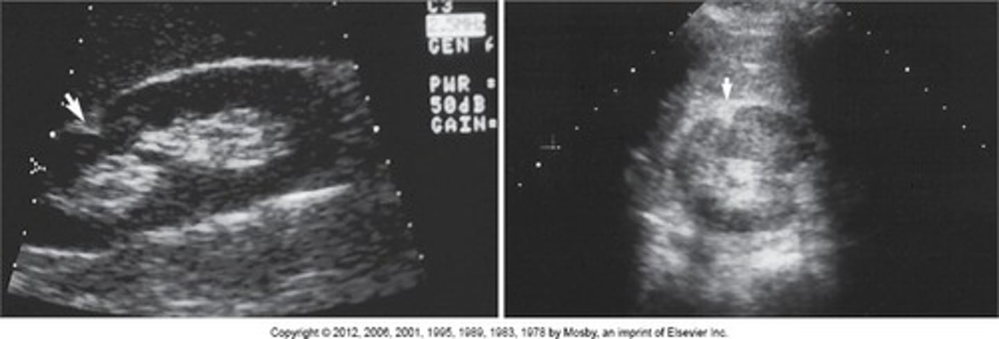 <p>a triangular or linear hyperechoic structure in the anterosuperior or posteroinferior surface of the kidney</p>