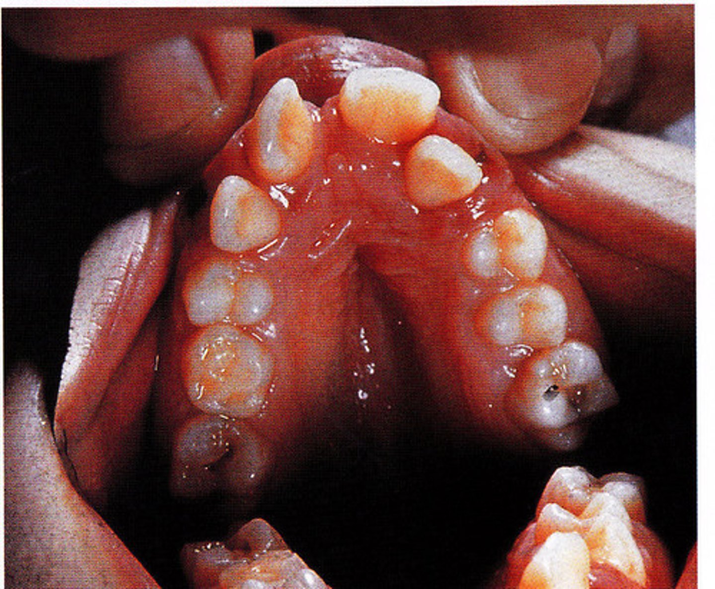 <p>-markedly high-arched palate and malpositioned teeth in a patient with mandibulofacial dysostosis</p><p>-also known as treacher collins syndrome</p><p>-results in a dysmorphic face, including downward sloping of the palpebral fissures.</p><p>-mouth appears fishlike</p>
