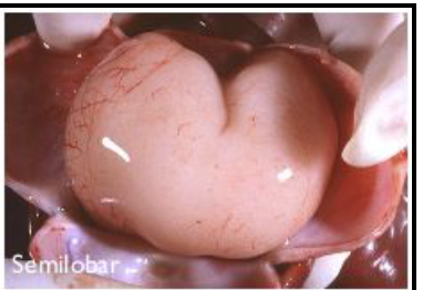 <p>rare brain disorder causing the brain’s surface to appear smooth due to lack of gyri and sulci; defective neuronal migration during 12-24 weeks gestation</p>