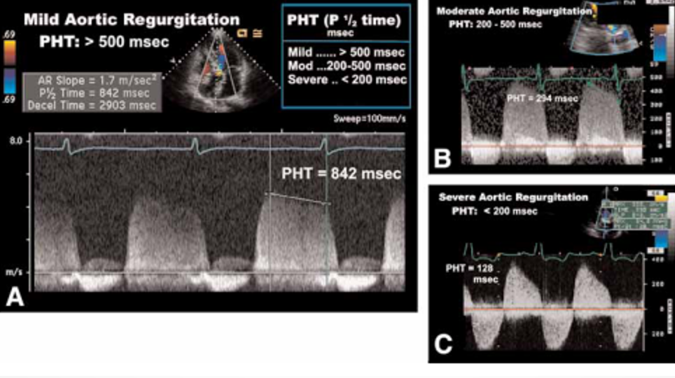 <p>severe : steep slope &lt;200ms</p><p>moderatie:&nbsp;200-500 ms</p><p>mild : flat slope &gt;500ms&nbsp;</p>