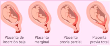 <ul><li><p><strong>Placenta previa total (o completa)</strong></p><ul><li><p>La placenta <strong>cubre completamente</strong> el orificio cervical interno.</p></li></ul></li><li><p><strong>Placenta previa parcial</strong></p><ul><li><p>La placenta <strong>cubre parcialmente</strong> el OCI.</p></li></ul></li><li><p><strong>Placenta previa marginal</strong></p><ul><li><p>El borde placentario <strong>alcanza el borde</strong> del OCI pero no lo cubre.</p></li></ul></li><li><p><strong>Placenta de inserción baja (low-lying)</strong></p><ul><li><p>La placenta está <strong>a menos de 2 cm del OCI</strong>, pero no lo toca ni cubre.</p></li></ul></li></ul><p></p>