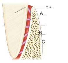 <p>A)dense cortical plate of bone that forms the tooth socket direc tly contacts the tooth root (cribiform plate)</p>