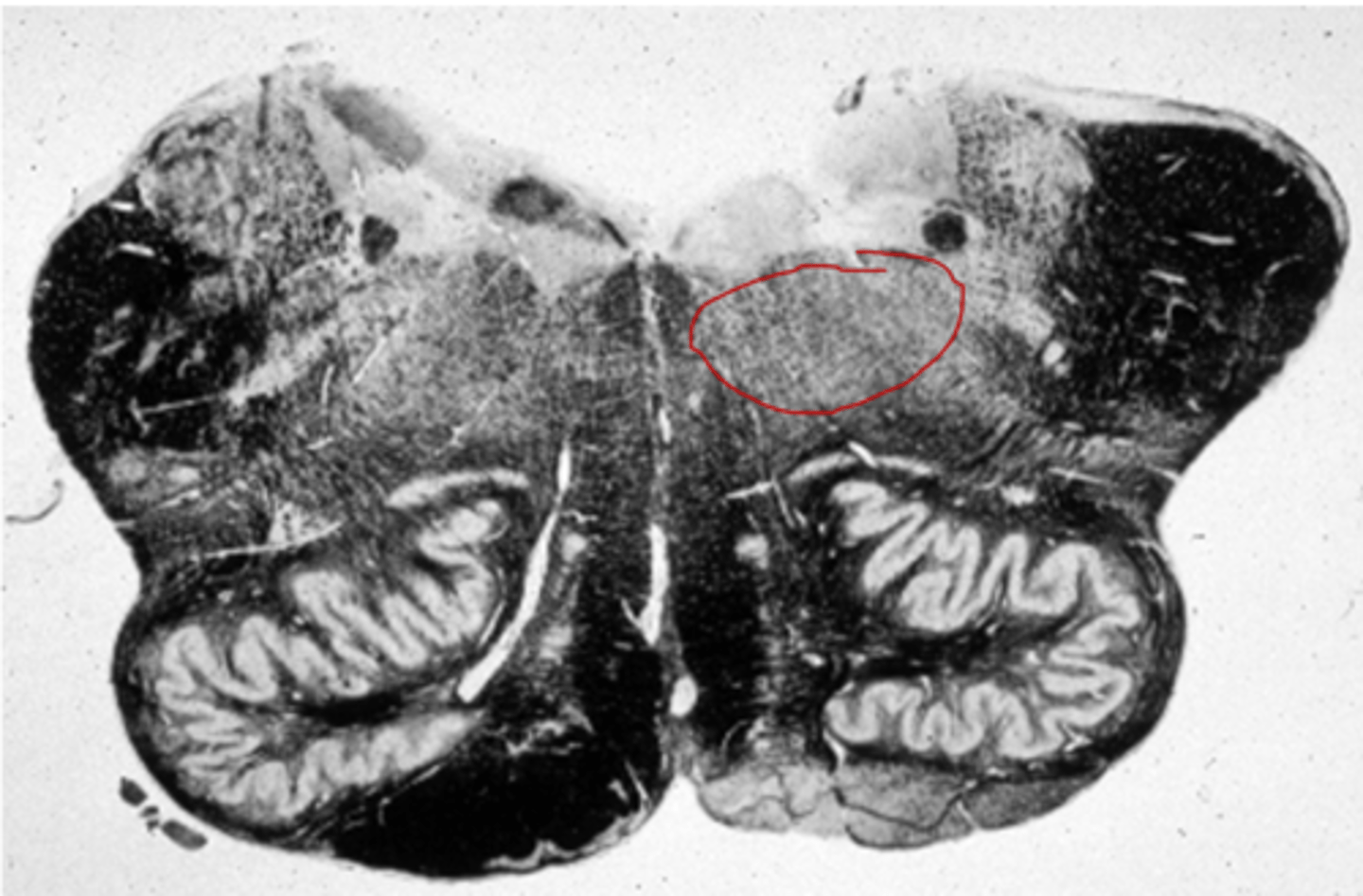 <p>-Loose network of nuclei extending throughout the medulla, pons, and mid brain</p><p>-Contains cardiac, vasomotor, and respiratory center</p>