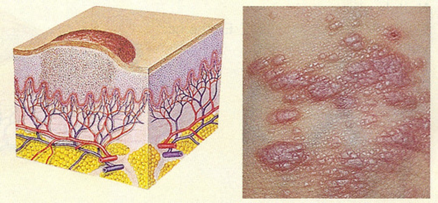 <p>primary lesion; a small elevation on the skin that contains no fluid but may contain pus</p>
