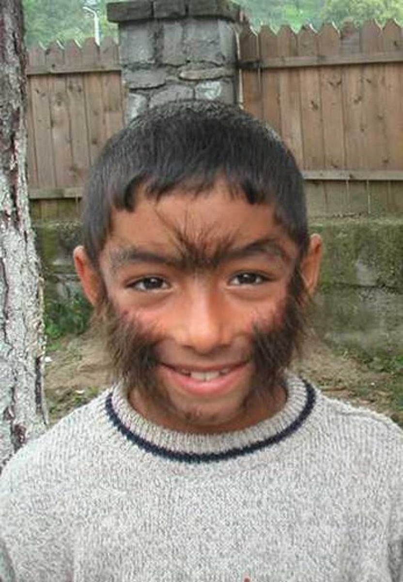 <p>(hirsuties) condition of abnormal growth of hair, characterized by the growth of terminal hair in areas of the body that normally grow only vellus hair.</p>
