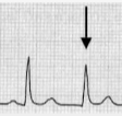 <p>hidden in the QRS → no P wave</p>