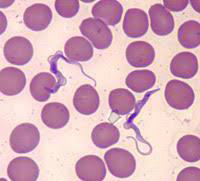 <p><strong>1. Identify the parasitic stage, and mention the disease caused by this parasite.</strong><br>→ <em>Polymorphic trypomastigotes</em><br>→ Disease: <strong>African trypanosomiasis (sleeping sickness)</strong></p><div data-type="horizontalRule"><hr></div><p><strong>2. Mention the stain used in this blood smear.</strong><br>→ <strong>Giemsa stain</strong></p><div data-type="horizontalRule"><hr></div><p><strong>3. Mention two diagnostic samples for detecting this parasite.</strong><br>→ - Chancre aspirate for Thick blood or buffy coat smears<br>→ - Lymph node aspirate, bone marrow, or cerebrospinal fluid (CSF)</p><div data-type="horizontalRule"><hr></div><p><strong>4. List haematological findings in this infection.</strong><br>→ - Anaemia and thrombocytopenia<br>→ - Moderate leukocytosis<br>→ - High levels of immunoglobulins, mainly IgM</p><div data-type="horizontalRule"><hr></div><p><strong>5. Mention the pathognomonic immune cell in CSF in this infection.</strong><br>→ <strong>Morula cell of Mott</strong></p>