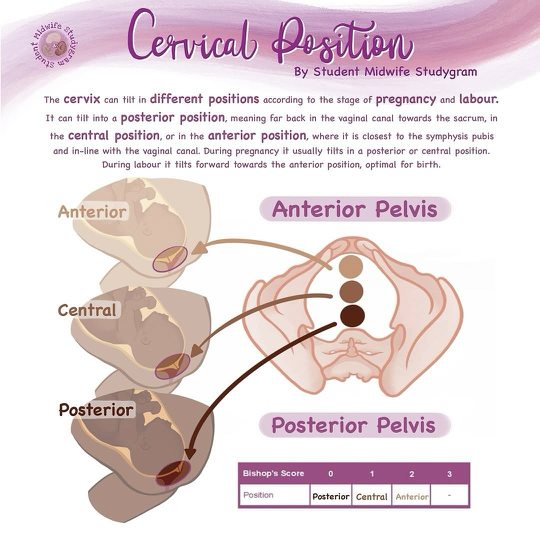 <ul><li><p>Describes location of cervix with respect to fetal presenting part </p><ul><li><p>Classified as posterior, mid-position, anterior </p></li><li><p>Progresses from posterior to anterior in labor </p></li></ul></li></ul><p></p><p></p><p></p>