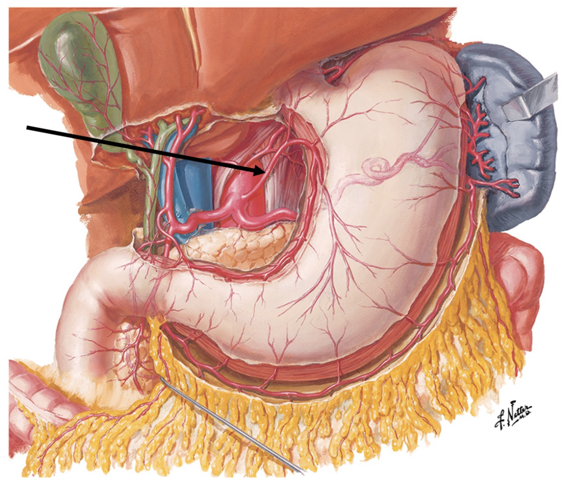 <p><span>If this artery were obstructed, blood could bypass the blockage and serve the proximal lesser curvature via an anastomosis with what vessel?&nbsp;</span></p>