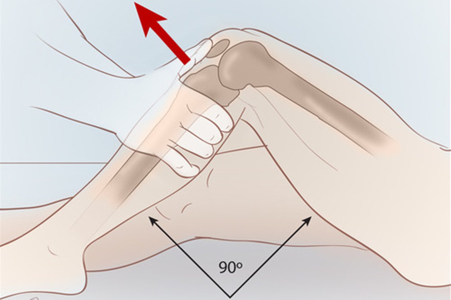 <p>What is a (+) anterior drawer test?</p>