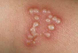 <p>vesicle</p>
