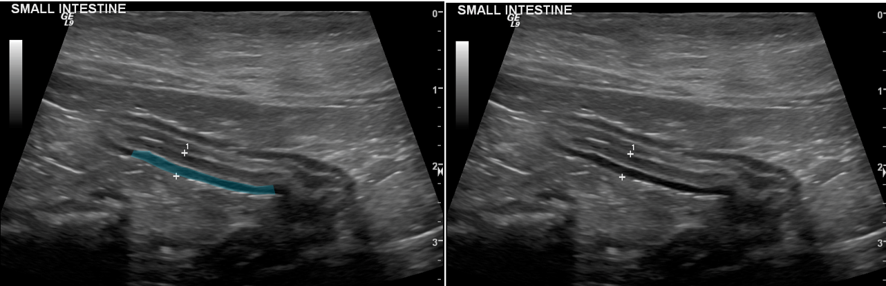 <p>Longitudinal section through a loop of small intestine viewed with ultrasonography. The + sign labeled 1 is in the lumen of the loop. The unlabeled image on the right is for reference.</p><p style="text-align: start">The hypoechoic area highlighted in blue in the left image below is the</p>