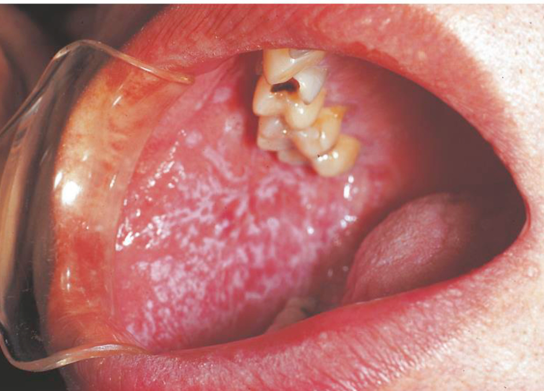 <p>Lichen planus&nbsp;</p>