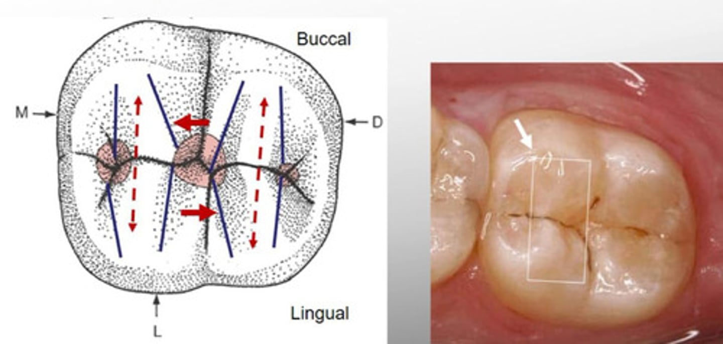 <p>Is a ridge crossing the occlusal surface of posterior teeth in B-L direction and made of connecting triangular ridges</p>