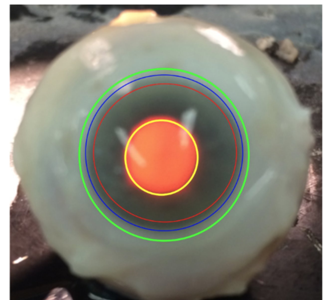 <p>Fascia Bulbi (Tenon's capsule) strongly adheres to episclera and conjunctiva</p>