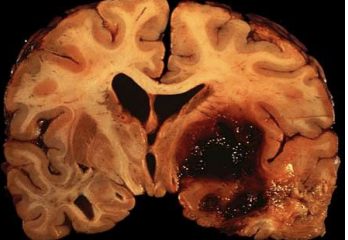 <ul><li><p>Hemorrhage into the brain and brainstem (bleeding in brain tissues). </p></li><li><p>Most common sites are the thalamus and basal ganglia </p><ul><li><p>Also possible: Brainstem (especially pons) and cerebellum </p></li></ul></li><li><p>May be caused by aneurysm: pouch formed in weakened arterial walls</p><ul><li><p> If aneurysm in cerebral artery bursts, severe aphasia is likely</p></li></ul></li></ul><p></p>