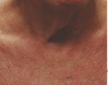 <p>red patches in sun-damaged areas with fine telangiectasias and area of both hyperpigmentations and hypopigmentations</p>