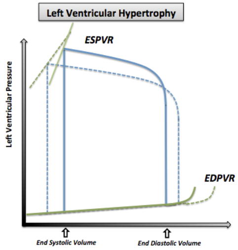 <p><strong>Normal/Decreased ESV:</strong> No systolic dysfunction</p><p><strong>Decreased EDV (Preload):</strong> LV hypertrophy = Decreased compliance + volume = Decreased SV and CO</p><p><strong>Increased Afterload: </strong>In LV outflow obstruction</p><p><strong>Steep EDPVR:</strong> Increased LV stiffness from hypertrophy = Decreased compliance + Diastolic function</p><ul><li><p>Low volume changes = High pressure changes</p></li></ul><p></p>