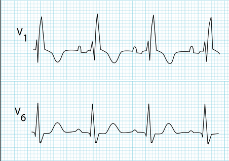 <p>type of abnormality + characteristics?</p>
