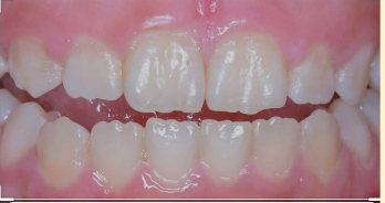 <p><mark data-color="blue" style="background-color: blue; color: inherit">incisor mamelons</mark></p>