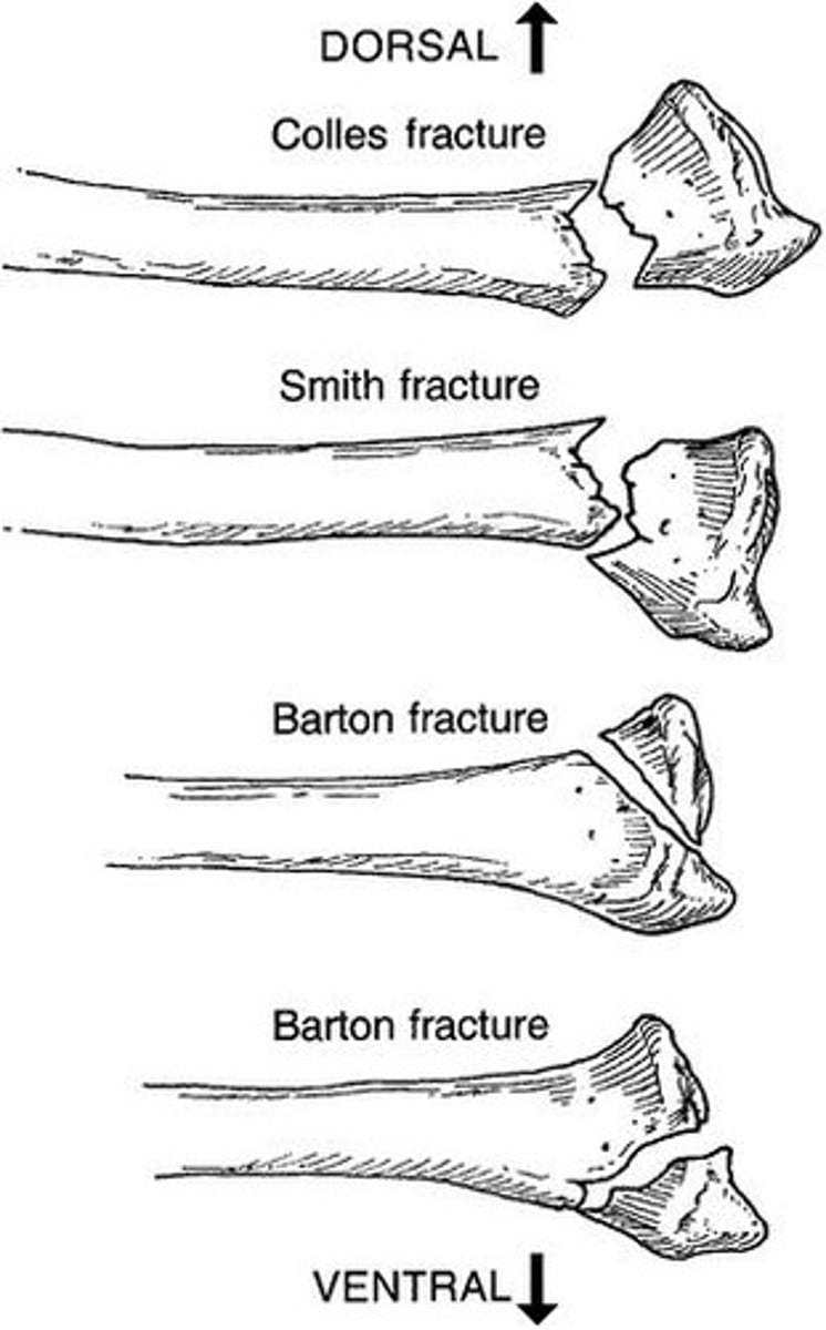 <p>An extra-articular distal radius fracture with dorsal angulation of the distal fragment</p>