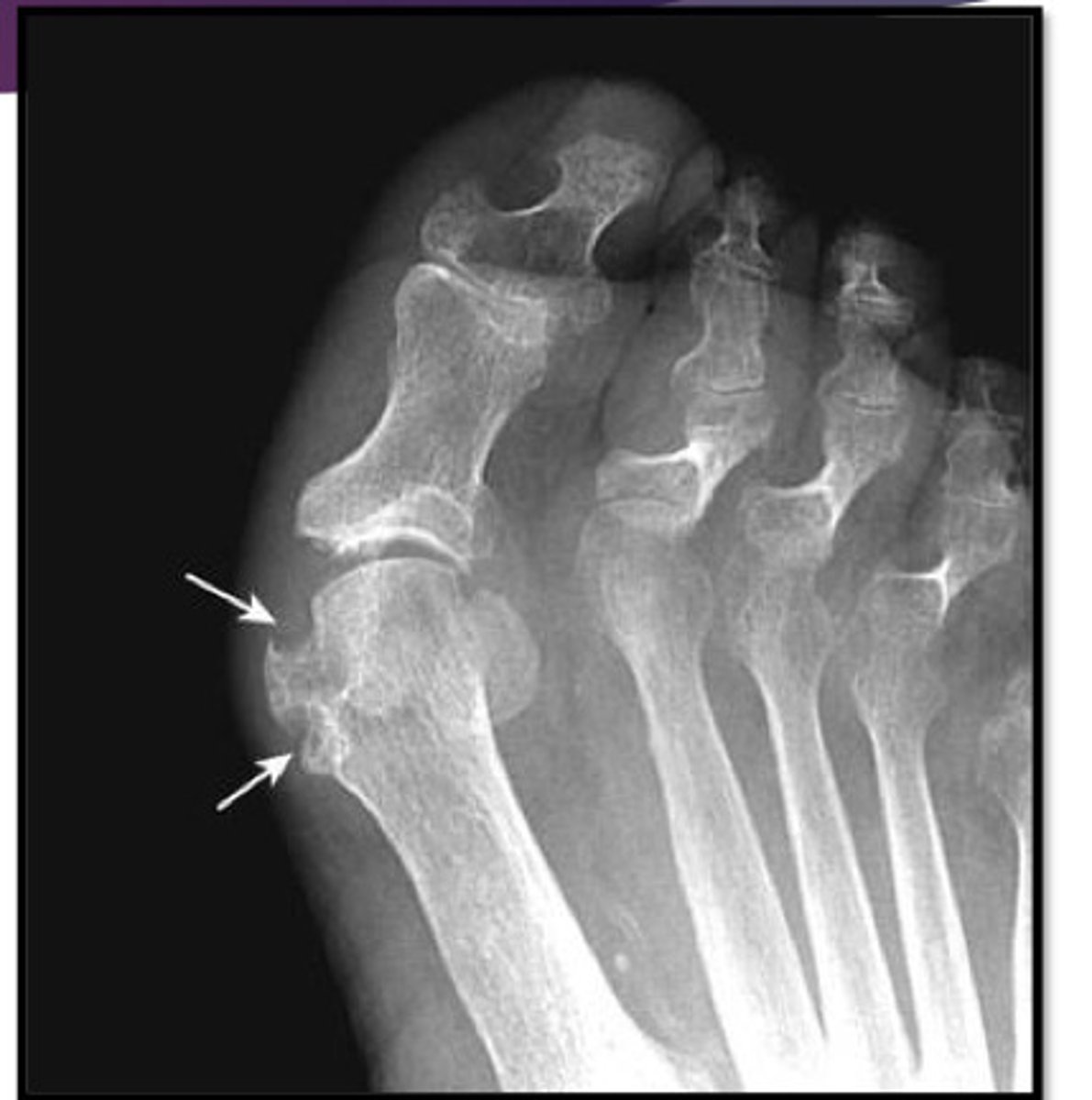 <p>inflammatory changes incited by deposition of calcium urate crystals in the joint</p><p>M&gt;F</p><p>monoarticular; asymmetrical later in course</p>