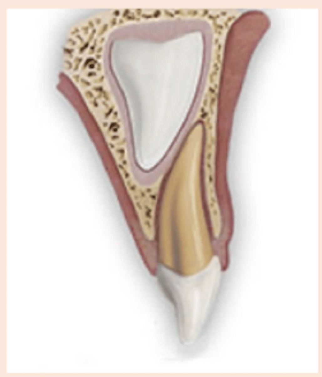 <p>b. Concussion</p>