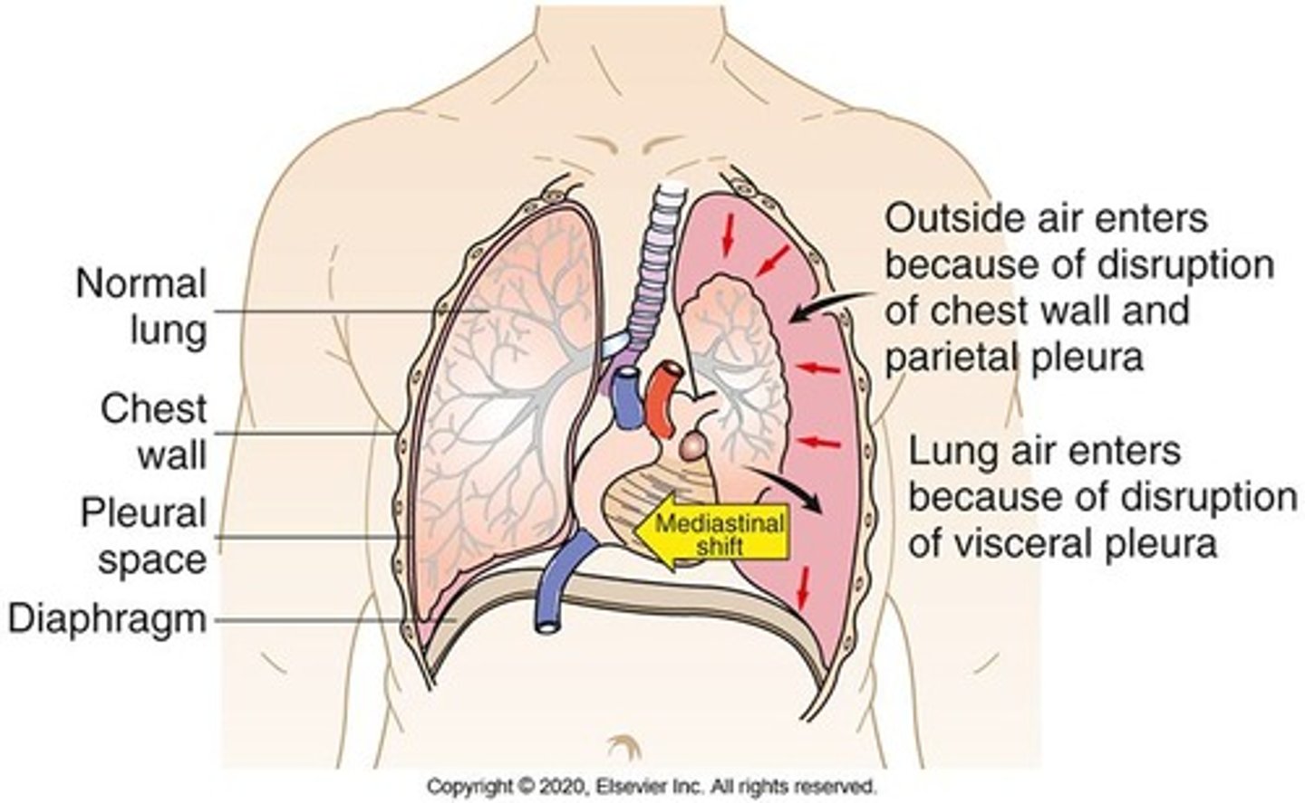 <p>Accumulation of air in the pleural space.</p>