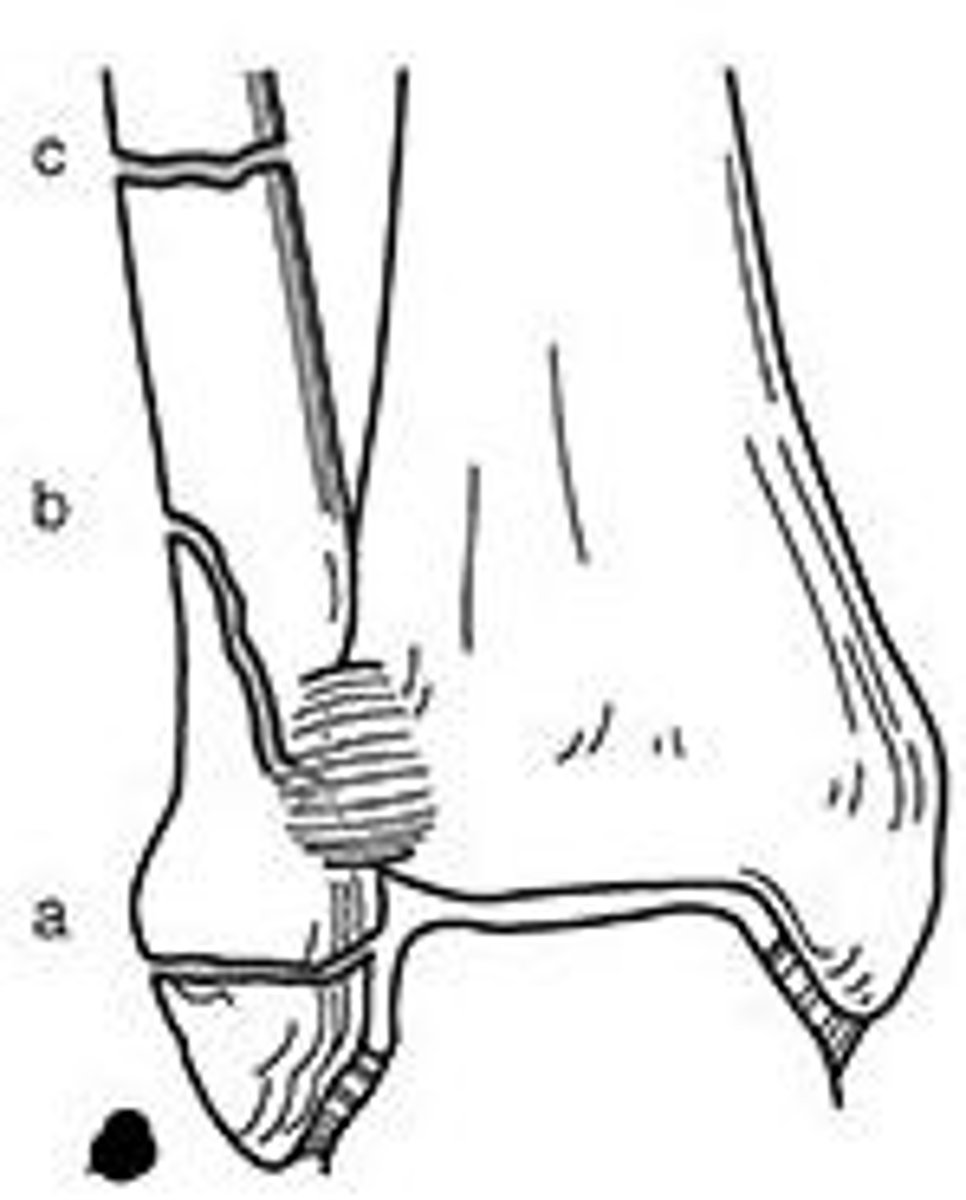 <p>A: fracture below the talar dome</p><p>B: fracture begins below the talar dome &amp; continues obliquely proximally</p><p>C: fracture is above the talar dome</p>