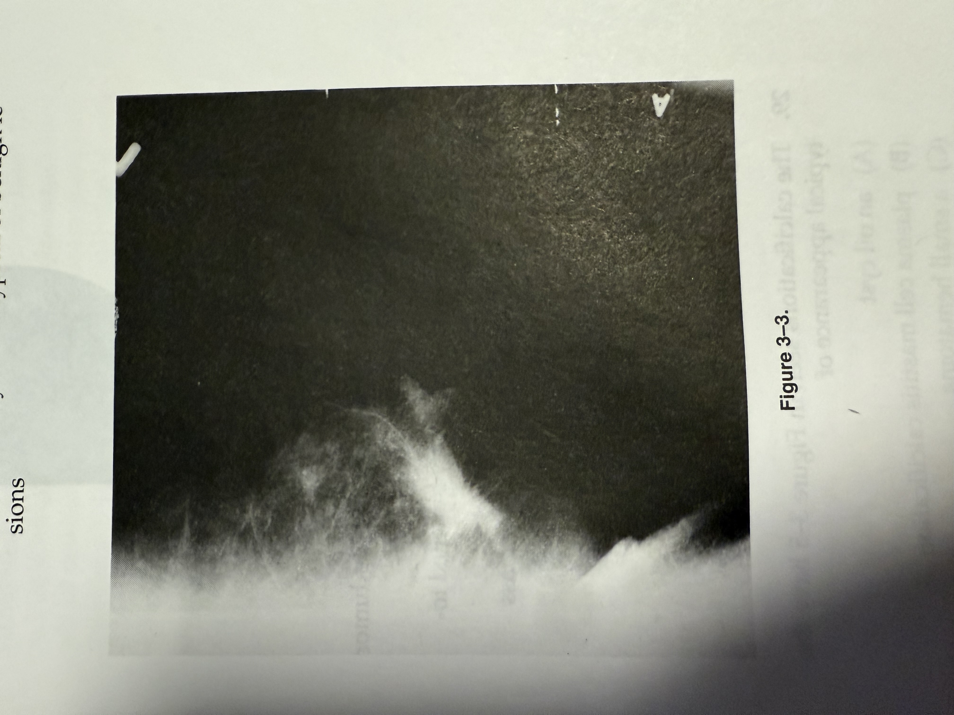 <p>The tumor seen in Figure 3-3 indicates</p><ol><li><p>﻿﻿﻿﻿invasive ductal breast carcinoma</p></li><li><p>﻿﻿﻿﻿a mammographically malignant tumor</p></li><li><p>﻿﻿﻿﻿a mammographically benign tumor</p></li><li><p>﻿﻿﻿﻿a low-density tumor typical of benign lesions</p></li></ol>
