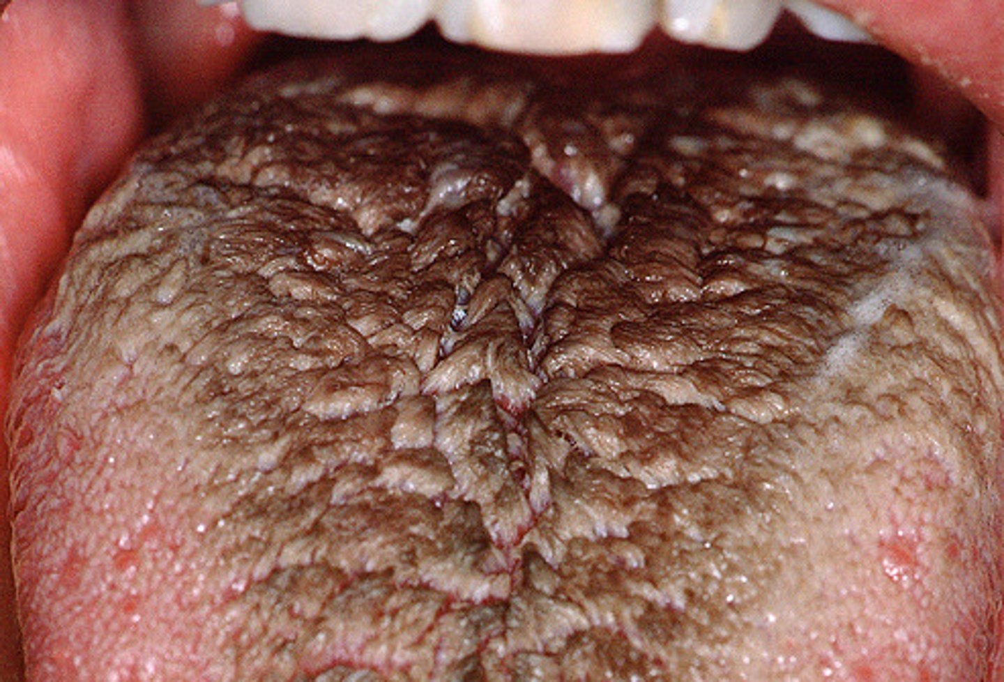<p>elongated filiform papillae that</p><p>produce a hair-like appearance</p><p>can pick up</p><p>yellow or brown stain and present an aesthetic problem for the patient</p>