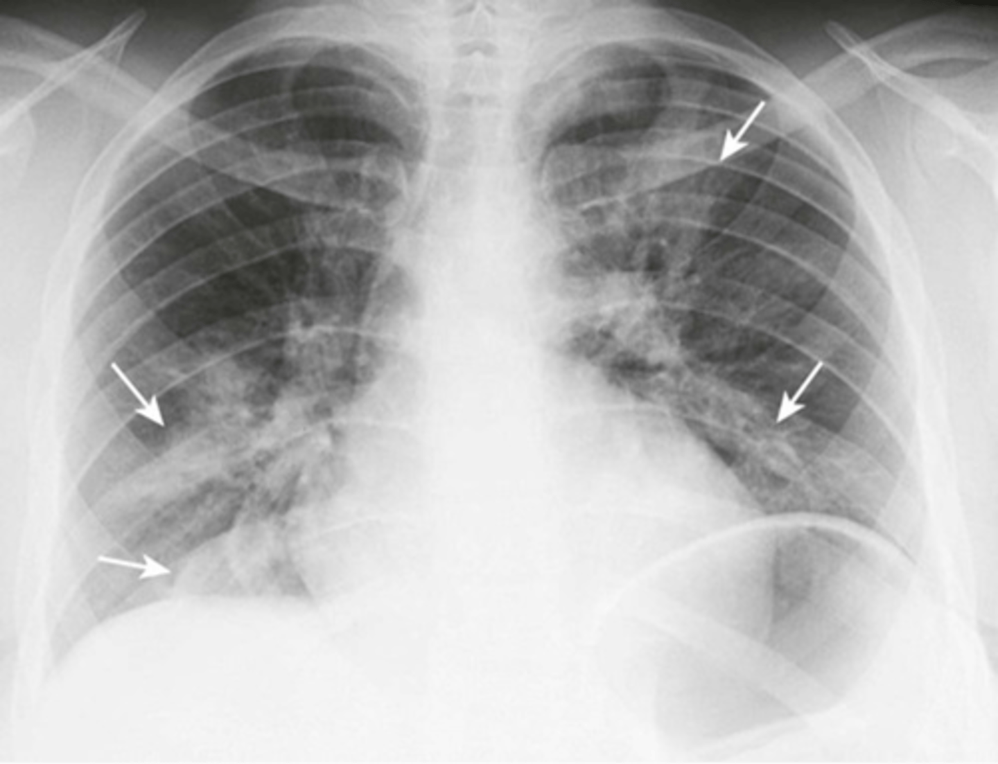 <p>-patches of airspaces in parts of both lungs</p>