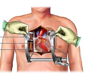 <p>Heart murmur</p>