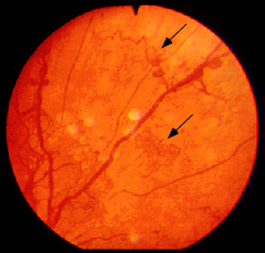Proliferative retinopathy